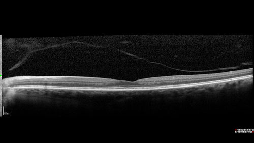 Late Onset Cone Dystrophy - Very Mild
Only IR and OCT show very mild bull's eye.  67 year old female with difficulty seeing in bright light
