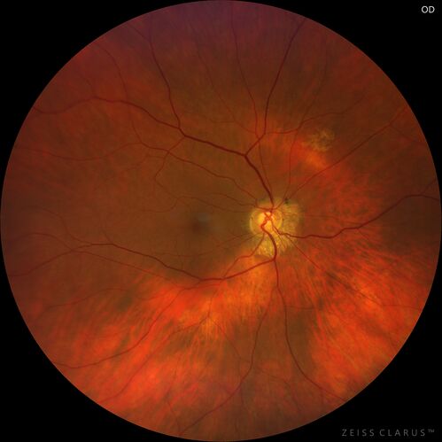 Mild Cone Dystrophy - CRX Mutation
65 year old  female with minimal symptoms and a mild cone dystrophy.
