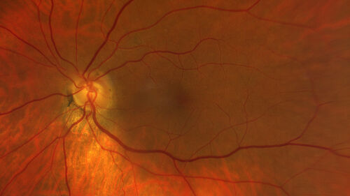 Mild Cone Dystrophy - CRX Mutation
65 year old  female with minimal symptoms and a mild cone dystrophy.
