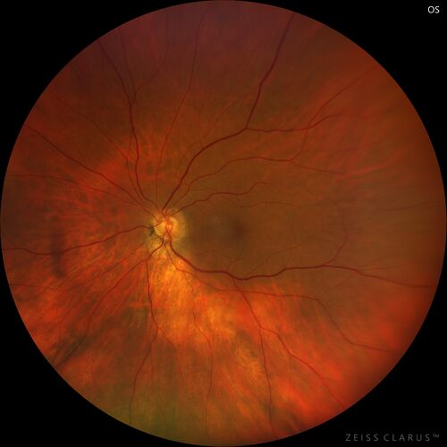 Mild Cone Dystrophy - CRX Mutation
65 year old  female with minimal symptoms and a mild cone dystrophy.
