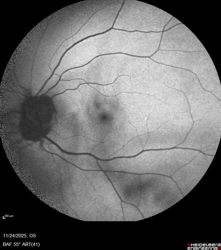 Mild Cone Dystrophy - CRX Mutation
65 year old  female with minimal symptoms and a mild cone dystrophy.
