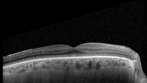 Mild Cone Dystrophy - CRX Mutation
65 year old  female with minimal symptoms and a mild cone dystrophy.
