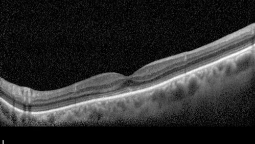 Mild Cone Dystrophy - CRX Mutation
65 year old  female with minimal symptoms and a mild cone dystrophy.
