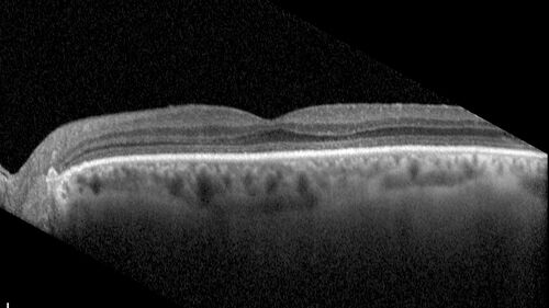Mild Cone Dystrophy - CRX Mutation
65 year old  female with minimal symptoms and a mild cone dystrophy.
