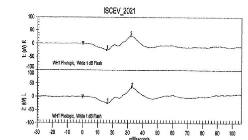 Mild Cone Dystrophy - CRX Mutation
65 year old  female with minimal symptoms and a mild cone dystrophy.
