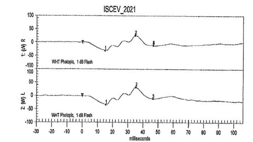 Mild Cone Dystrophy - CRX Mutation
65 year old  female with minimal symptoms and a mild cone dystrophy.
