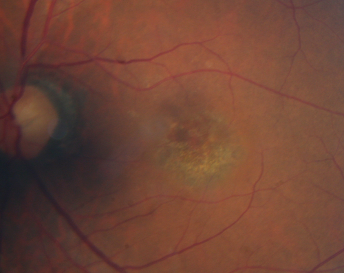 Cone Dystrophy - Autosomal Recessive
74 year old man with 20/25 vision OD and subtle bull's eye on FAF.  Left eye is 20/200 with atrophy of the outer retina centrally
