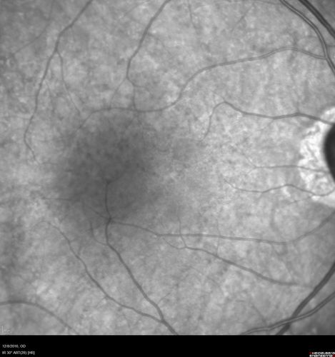 Cone Dystrophy - Autosomal Recessive
74 year old man with 20/25 vision OD and subtle bull's eye on FAF.  Left eye is 20/200 with atrophy of the outer retina centrally
