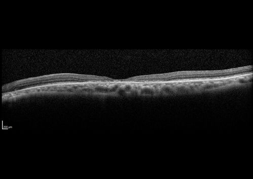 Cone Dystrophy - Autosomal Recessive
74 year old man with 20/25 vision OD and subtle bull's eye on FAF.  Left eye is 20/200 with atrophy of the outer retina centrally

