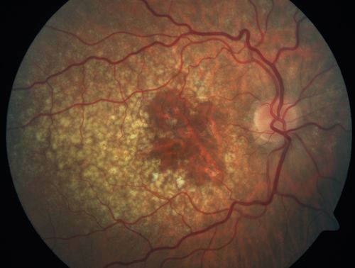 Dry AMD - Confluent Drusen Sparing Center of Macula which has Atrophy
65 year old woman, VA 20/40 OD; 20/80 OS.  The center of the macula has few or no drusen with predominantly non-geographic atrophy

