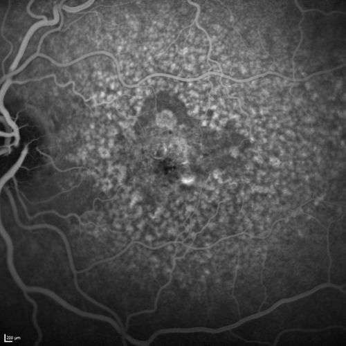 Dry AMD - Confluent Drusen Sparing Center of Macula which has Atrophy
65 year old woman, VA 20/40 OD; 20/80 OS.  The center of the macula has few or no drusen with predominantly non-geographic atrophy
