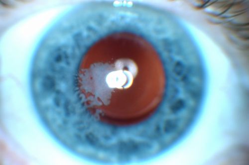 Post Lasik Epithelial Ingrowth
58-year-old man had a vitrectomy for a macular pucker in the right eye almost two years ago.  His vision was good after his cornea surgeon removed the cells from his flap but then recently the cells have regrown and his vision has declined again.
OD is 20/100.
