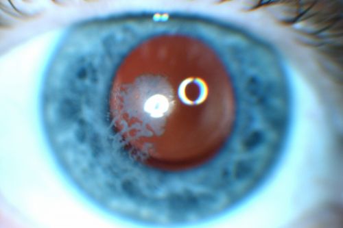 Post Lasik Epithelial Ingrowth
58-year-old man had a vitrectomy for a macular pucker in the right eye almost two years ago.  His vision was good after his cornea surgeon removed the cells from his flap but then recently the cells have regrown and his vision has declined again.
OD is 20/100.
