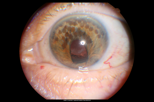 Correctopia - post laser iridoplasty - 20/20 vision
1 month after the iridoplasty, her vision was 20/20.  She began to improve on the drive home from the treatment.  The laser setting were : green argon 500 microns, 500 mw, 500 msec.
