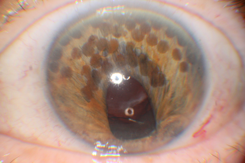 Correctopia - post laser iridoplasty - 20/20 vision
1 month after the iridoplasty, her vision was 20/20.  She began to improve on the drive home from the treatment.  The laser setting were : green argon 500 microns, 500 mw, 500 msec.
