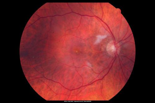 Cotton Wool Spots and New Diagnosis of Chronic Lymphocytic leukemia
73-year-old man with cotton wool spots diagnosed subsequently with with Chronic Lymphocytice Leukemia
