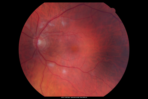 Cotton Wool Spots and New Diagnosis of Chronic Lymphocytic leukemia
73-year-old man with cotton wool spots diagnosed subsequently with with Chronic Lymphocytice Leukemia

