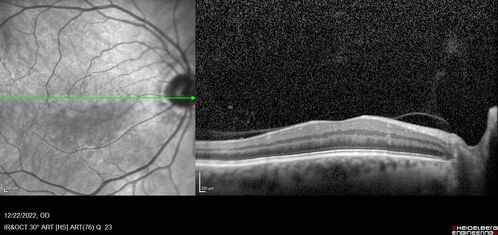 Cilioretinal artery occlusion following cataract surgery
60 year old man noticed new scotoma in the right eye immediately after cataract surgery.  Vision is 20/60
