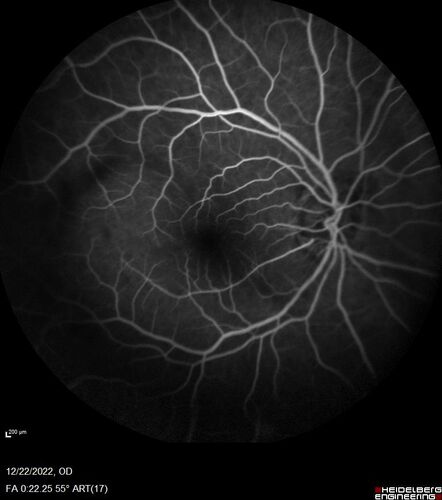 Cilioretinal artery occlusion following cataract surgery
60 year old man noticed new scotoma in the right eye immediately after cataract surgery.  Vision is 20/60
