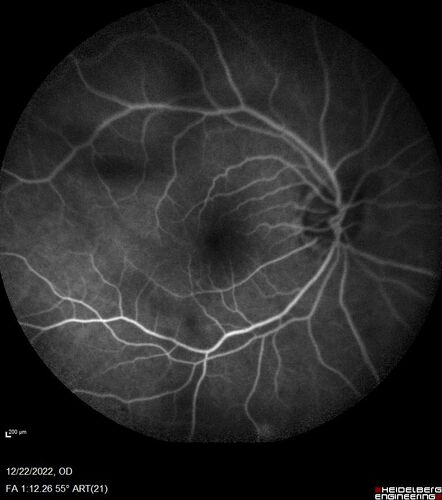 Cilioretinal artery occlusion following cataract surgery
60 year old man noticed new scotoma in the right eye immediately after cataract surgery.  Vision is 20/60
