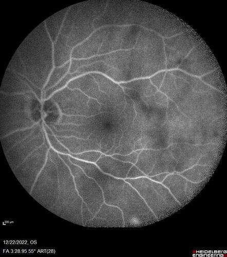 Cilioretinal artery occlusion following cataract surgery
60 year old man noticed new scotoma in the right eye immediately after cataract surgery.  Vision is 20/60
