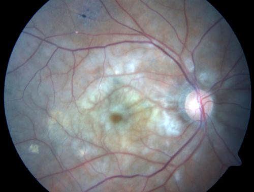 80 Year old man with 3 day history of vision loss right eye.  Vision 4/200.
