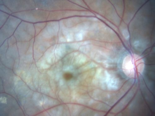 80 Year old man with 3 day history of vision loss right eye.  Vision 4/200.
