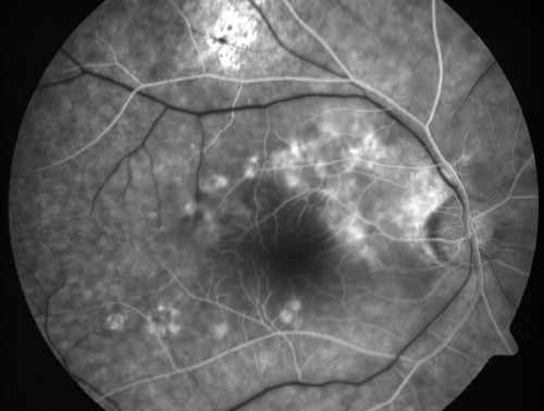 80 Year old man with 3 day history of vision loss right eye.  Vision 4/200.
