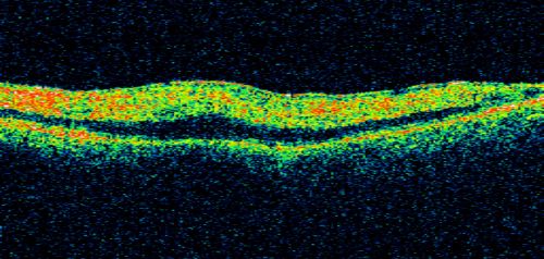 80 Year old man with 3 day history of vision loss right eye.  Vision 4/200.
