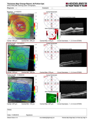 Central Retinal Artery Occlusion - MAP
Progression from acute to atrophy - decreasing retinal thickenss
