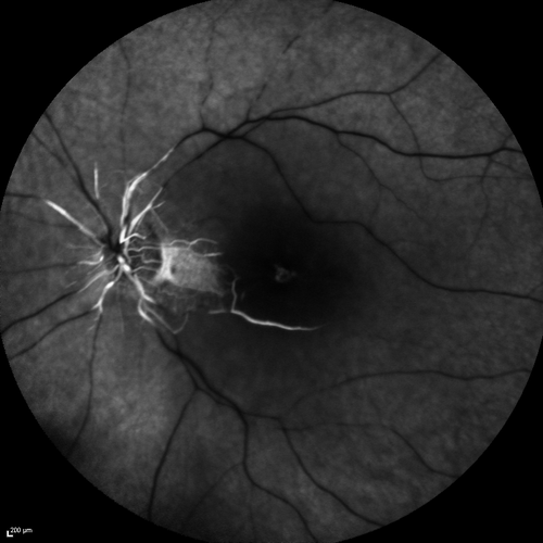 Central Retinal Artery Occlusion with Cilioretinal Sparing - Acute - FA Very Slow Filling CRA
 77-year-old man was doing fine until midnight of last night when he noticed sudden severe vision loss in the left eye. VISUAL ACUITY:  OD 20/20,  OS 2/200.
