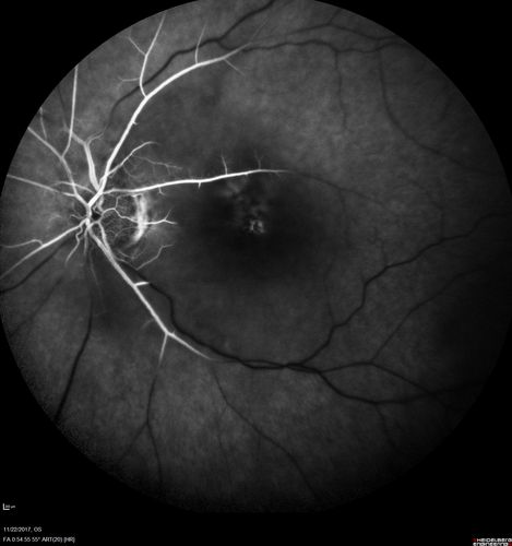 Central Retinal Artery Occlusion then Neovascular Glaucoma
81  year old male with sudden vision loss. 2 months later developed NVG

