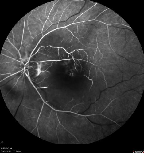 Central Retinal Artery Occlusion then Neovascular Glaucoma
81  year old male with sudden vision loss. 2 months later developed NVG
