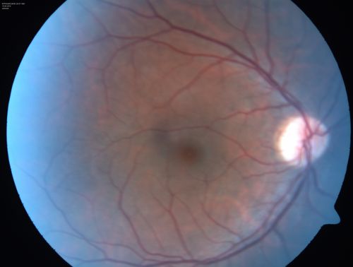 Central retinal artery and vein occlusion - Protein C Deficiency 33 year old male
33 year old male with vision loss for 3 hours.  VA 20/12 right eye, 5/200 left eye.  He has a protein C deficiency.  The left eye recovered vision in about 1 month to 20/16.  FA shows very slow recirculation time.
