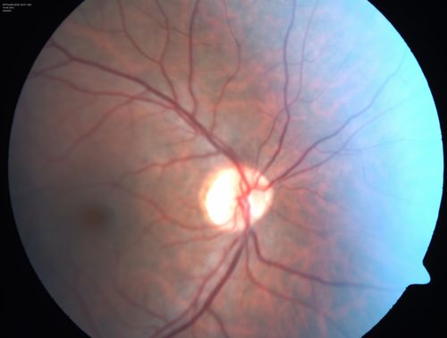 Central retinal artery and vein occlusion - Protein C Deficiency 33 year old male
33 year old male with vision loss for 3 hours.  VA 20/12 right eye, 5/200 left eye.  He has a protein C deficiency.  The left eye recovered vision in about 1 month to 20/16.  FA shows very slow recirculation time.
