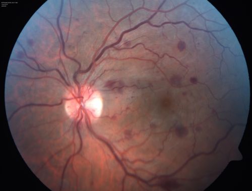 Central retinal artery and vein occlusion - Protein C Deficiency 33 year old male
33 year old male with vision loss for 3 hours.  VA 20/12 right eye, 5/200 left eye.  He has a protein C deficiency.  The left eye recovered vision in about 1 month to 20/16.  FA shows very slow recirculation time.
