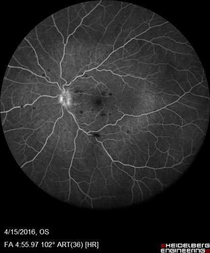 Central retinal artery and vein occlusion - Protein C Deficiency 33 year old male
33 year old male with vision loss for 3 hours.  VA 20/12 right eye, 5/200 left eye.  He has a protein C deficiency.  The left eye recovered vision in about 1 month to 20/16.  FA shows very slow recirculation time.
