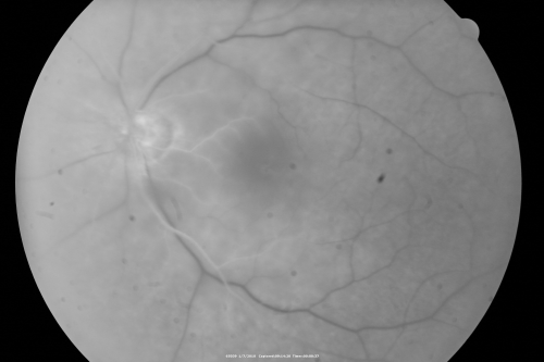 Central Retinal Artery Occlusion Left Eye 2 Weeks Old - Still Non-Perfusion
85-year-old woman who had sudden severevision loss in the left eye two weeks ago.   she can see a little more centrally and much more in the periphery, since about the last four days. 

VISUAL ACUITY:  OD 20/30,  OS: Hand motion
Keywords: cherry red spot;retinal edema;crao