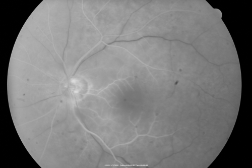 Central Retinal Artery Occlusion Left Eye 2 Weeks Old - Still Non-Perfusion
85-year-old woman who had sudden severevision loss in the left eye two weeks ago.   she can see a little more centrally and much more in the periphery, since about the last four days. 

VISUAL ACUITY:  OD 20/30,  OS: Hand motion
Keywords: cherry red spot;retinal edema;crao
