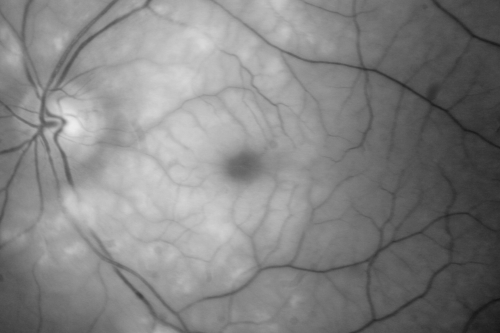 Central Retinal Artery Occlusion Left Eye 2 Weeks Old - Still Non-Perfusion
85-year-old woman who had sudden severevision loss in the left eye two weeks ago.   she can see a little more centrally and much more in the periphery, since about the last four days. 

VISUAL ACUITY:  OD 20/30,  OS: Hand motion
Keywords: cherry red spot;retinal edema;crao