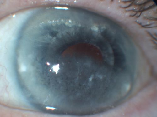 Silicone Oil in Anterior Chamber and Band Keratopathy 8 Years Post Complex Retinal Detachment Repair
81-year-old man had complex retinal detachment repairs in both eyes with silicone oil 8 years ago. The left eye has an oil fill.  He had a retinotomy very near to the macula and he has had silicone oil in the eye for a few years.  His eye is comfortable and the vision is stable.  OD is 20/200, OS is light perception
