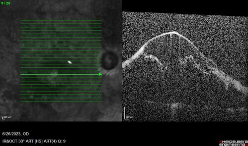 CRVO with severe capillary non-perfusion
95 year old female 2-3 days of severe vision loss in the right eye.
The left eye lost vision to wet AMD after having a 8 month gap in therapy between 1/2020 (VA 20/50 OU) and 9/2020 (VA 20/25 OD, HM OS - COVID).  
PMHx: DM (on no medications), Thyroid
Meds: Artificial tears
VA HM OU
IOP: 18,19
Anterior segment: no rubeosis, pseudophakic
images look like vision loss was more than a few days in the right eye.
