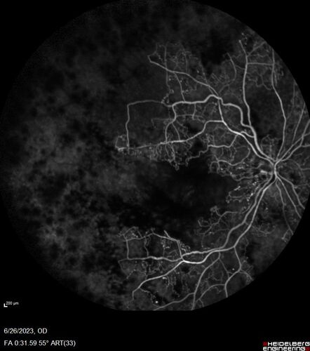 CRVO with severe capillary non-perfusion
95 year old female 2-3 days of severe vision loss in the right eye.
The left eye lost vision to wet AMD after having a 8 month gap in therapy between 1/2020 (VA 20/50 OU) and 9/2020 (VA 20/25 OD, HM OS - COVID).  
PMHx: DM (on no medications), Thyroid
Meds: Artificial tears
VA HM OU
IOP: 18,19
Anterior segment: no rubeosis, pseudophakic
images look like vision loss was more than a few days in the right eye.
