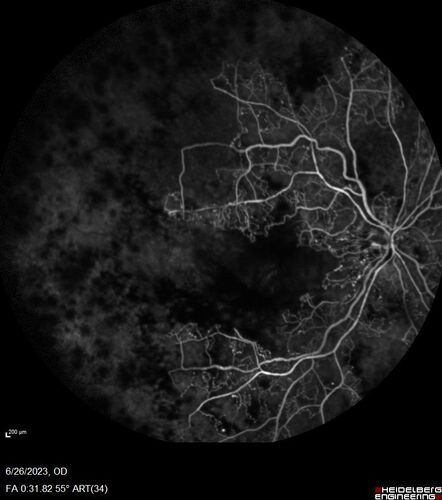 CRVO with severe capillary non-perfusion
95 year old female 2-3 days of severe vision loss in the right eye.
The left eye lost vision to wet AMD after having a 8 month gap in therapy between 1/2020 (VA 20/50 OU) and 9/2020 (VA 20/25 OD, HM OS - COVID).  
PMHx: DM (on no medications), Thyroid
Meds: Artificial tears
VA HM OU
IOP: 18,19
Anterior segment: no rubeosis, pseudophakic
images look like vision loss was more than a few days in the right eye.

