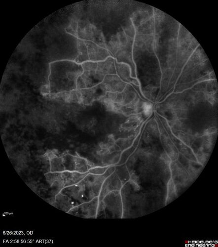 CRVO with severe capillary non-perfusion
95 year old female 2-3 days of severe vision loss in the right eye.
The left eye lost vision to wet AMD after having a 8 month gap in therapy between 1/2020 (VA 20/50 OU) and 9/2020 (VA 20/25 OD, HM OS - COVID).  
PMHx: DM (on no medications), Thyroid
Meds: Artificial tears
VA HM OU
IOP: 18,19
Anterior segment: no rubeosis, pseudophakic
images look like vision loss was more than a few days in the right eye.
