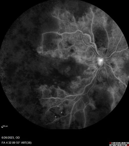 CRVO with severe capillary non-perfusion
95 year old female 2-3 days of severe vision loss in the right eye.
The left eye lost vision to wet AMD after having a 8 month gap in therapy between 1/2020 (VA 20/50 OU) and 9/2020 (VA 20/25 OD, HM OS - COVID).  
PMHx: DM (on no medications), Thyroid
Meds: Artificial tears
VA HM OU
IOP: 18,19
Anterior segment: no rubeosis, pseudophakic
images look like vision loss was more than a few days in the right eye.
