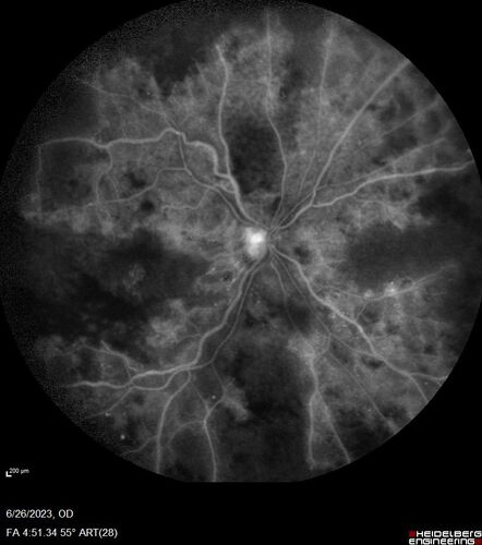 CRVO with severe capillary non-perfusion
95 year old female 2-3 days of severe vision loss in the right eye.
The left eye lost vision to wet AMD after having a 8 month gap in therapy between 1/2020 (VA 20/50 OU) and 9/2020 (VA 20/25 OD, HM OS - COVID).  
PMHx: DM (on no medications), Thyroid
Meds: Artificial tears
VA HM OU
IOP: 18,19
Anterior segment: no rubeosis, pseudophakic
images look like vision loss was more than a few days in the right eye.
