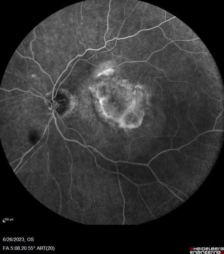 CRVO with severe capillary non-perfusion
95 year old female 2-3 days of severe vision loss in the right eye.
The left eye lost vision to wet AMD after having a 8 month gap in therapy between 1/2020 (VA 20/50 OU) and 9/2020 (VA 20/25 OD, HM OS - COVID).  
PMHx: DM (on no medications), Thyroid
Meds: Artificial tears
VA HM OU
IOP: 18,19
Anterior segment: no rubeosis, pseudophakic
images look like vision loss was more than a few days in the right eye.
