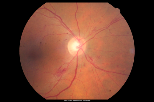 Trousseau Sign - CRVO and Pancreatic Cancer
Left eye shows CRVO with severe edema.  The right eye has multiple small hemorrhages.  Some of this is probably anemic retinopathy and some from hypercoaguability of cancer.  The patient has pancreatic cancer.
