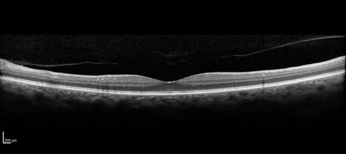Trousseau Sign - CRVO and Pancreatic Cancer
Left eye shows CRVO with severe edema.  The right eye has multiple small hemorrhages.  Some of this is probably anemic retinopathy and some from hypercoaguability of cancer.  The patient has pancreatic cancer.
